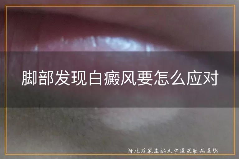 脚部发现白癜风要怎么应对