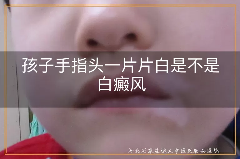孩子手指头一片片白是不是白癜风