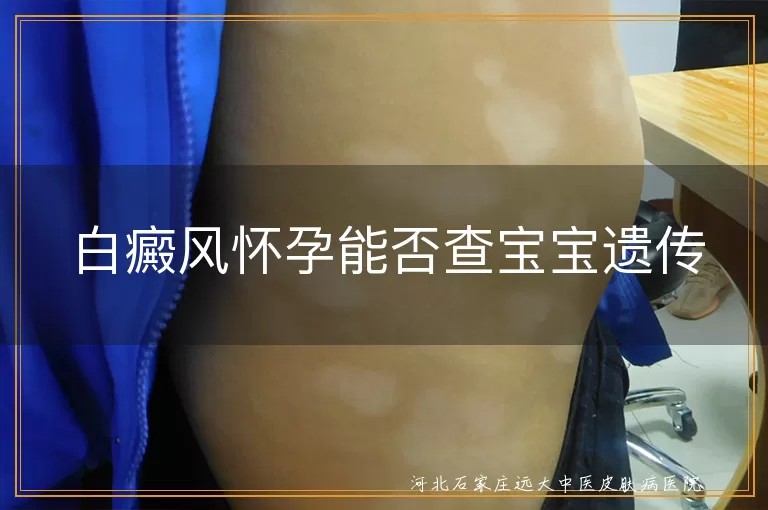白癜风怀孕能否查宝宝遗传