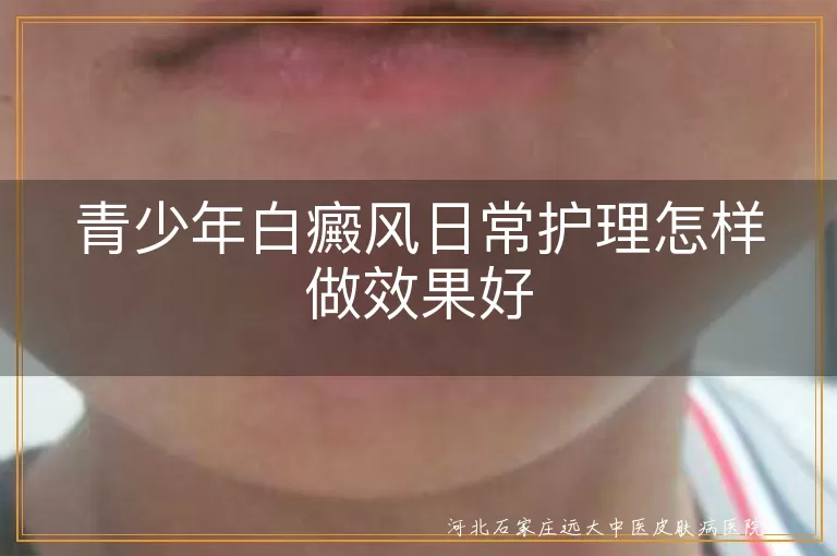 青少年白癜风日常护理怎样做效果好