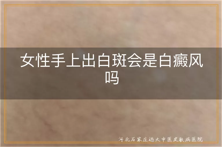 女性手上长白斑是白癜风吗,手部白斑是不是白癜风症状,女性手出白斑会是白癜风吗