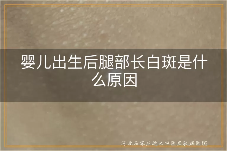 宝宝腿部长白斑是不是白癜风,婴儿出生就有白斑怎么回事,新生儿腿部出现白斑的原因