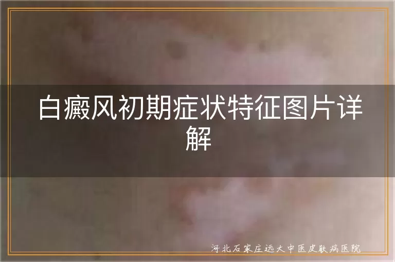 白癜风初期症状特征图片详解