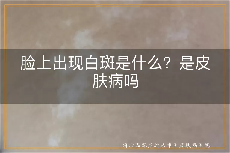 脸上白斑是白癜风吗怎么辨别,脸上长白斑是哪种皮肤病,脸上白斑是白癜风吗会传染吗