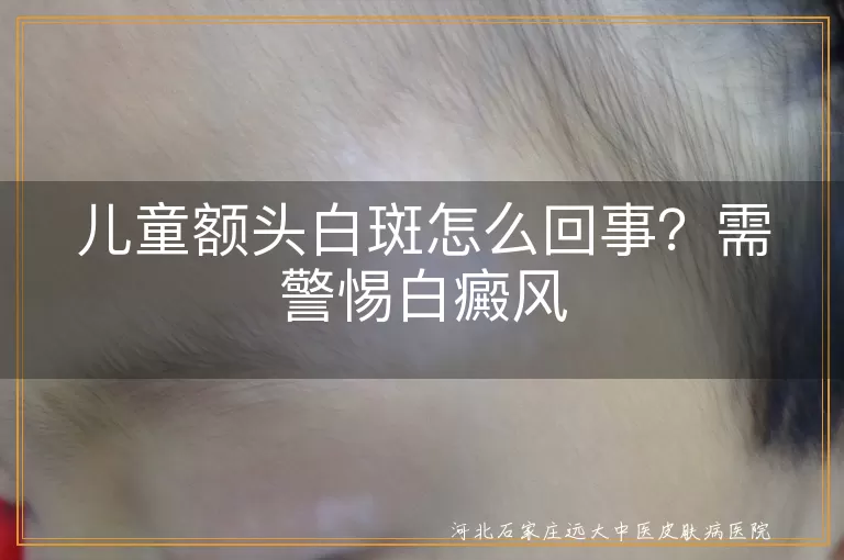 儿童额头白斑怎么回事,孩子额头有白斑是白癜风吗,额头白块警惕白癜风