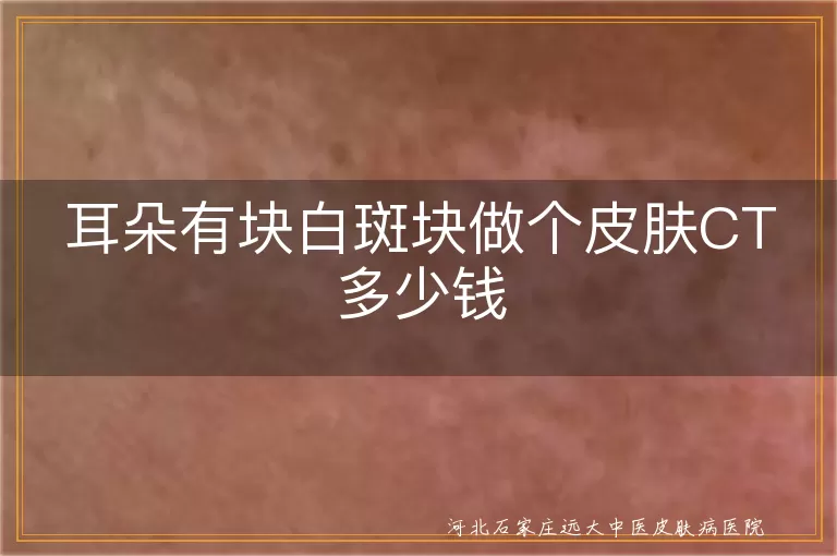 耳朵有白斑做皮肤CT多少钱,耳朵白斑块是白癜风如何查,耳朵长白斑CT检查费用咨询