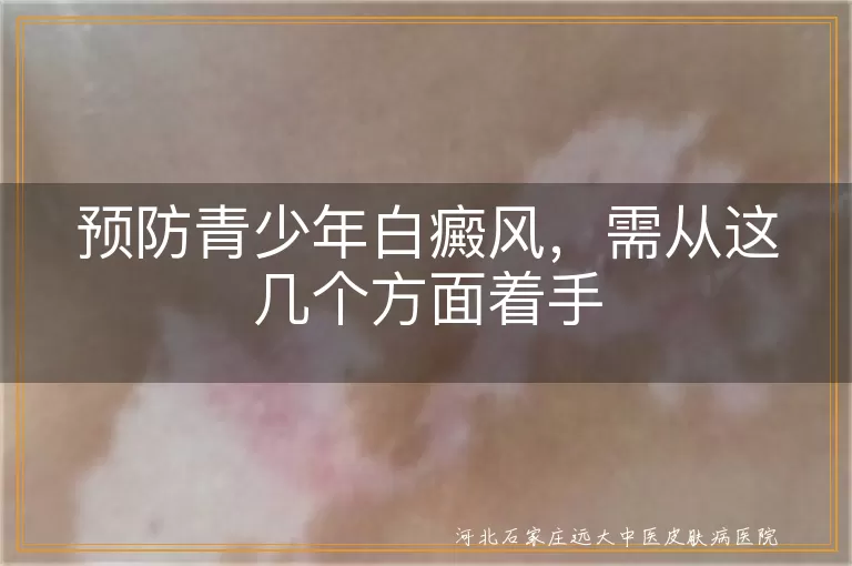 青少年白癜风预防重点有哪些方面,青少年白斑预防要关注哪些关键点,青少年防白癜风应从哪些方面努力
