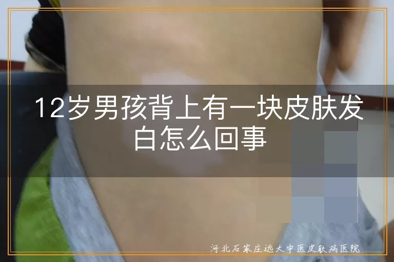 12岁男孩背部白斑是白癜风吗,孩子背上皮肤发白是不是白斑病,男生后背出现白块警惕白癜风症状