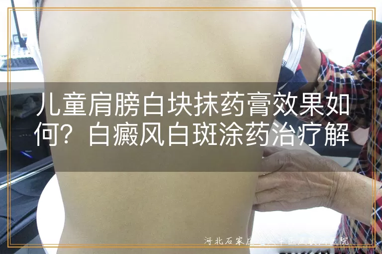 儿童肩膀白斑涂药膏效果好不好,孩子肩膀白癜风白块用药能消吗,小孩肩膀有白斑抹药管用吗