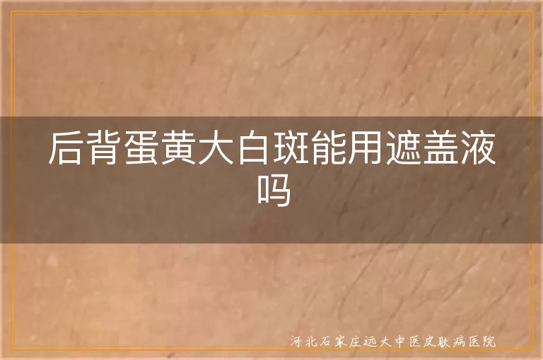 后背蛋黄大白斑的遮盖办法白癜风, 后背白斑能用遮盖液吗白癜风患者, 后背出现蛋黄大白癜风白斑可否遮盖