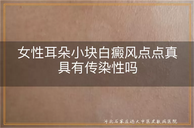 女性耳朵小块白癜风点点真具有传染性吗