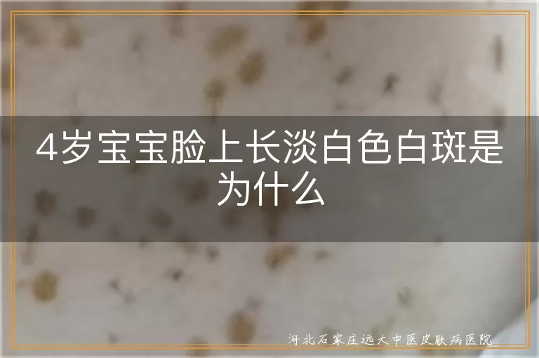 宝宝脸上白斑是白癜风吗,小孩面部淡白色斑块原因,4岁儿童脸上长白斑怎么回事