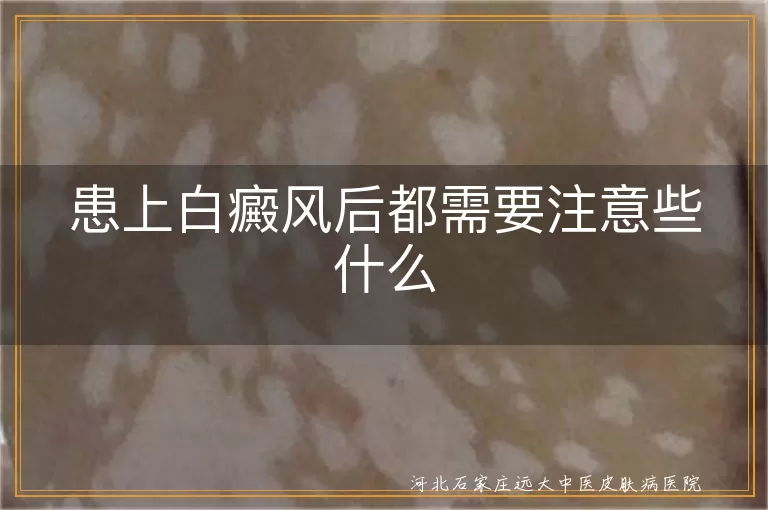 患上白癜风后护理要点汇总,白癜风患者日常注意事宜,白斑生活细节调整须知
