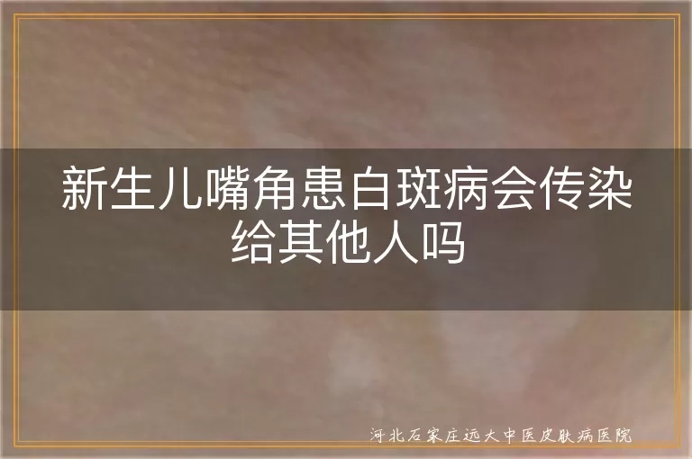 新生儿嘴角白癜风会传染吗,婴儿嘴角长白斑传染别人吗,宝宝嘴角白斑会不会传染人