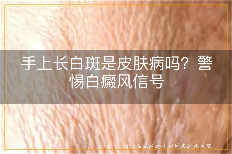 手上长白斑是皮肤病吗?警惕白癜风信号