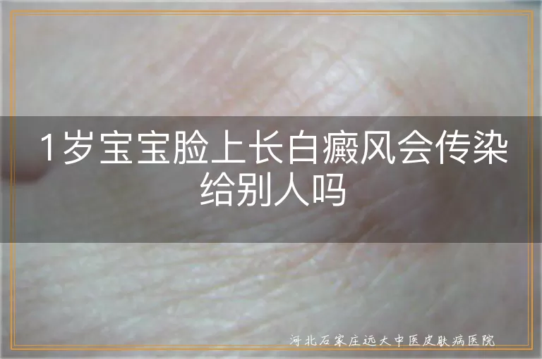 1岁宝宝脸上长白癜风会传染给别人吗