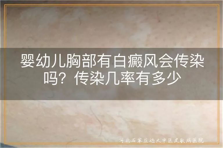 婴幼儿胸口白癜风会传染给别人吗,宝宝胸前长白斑会传染人吗几率多少,婴儿白癜风传染机率为零别担心