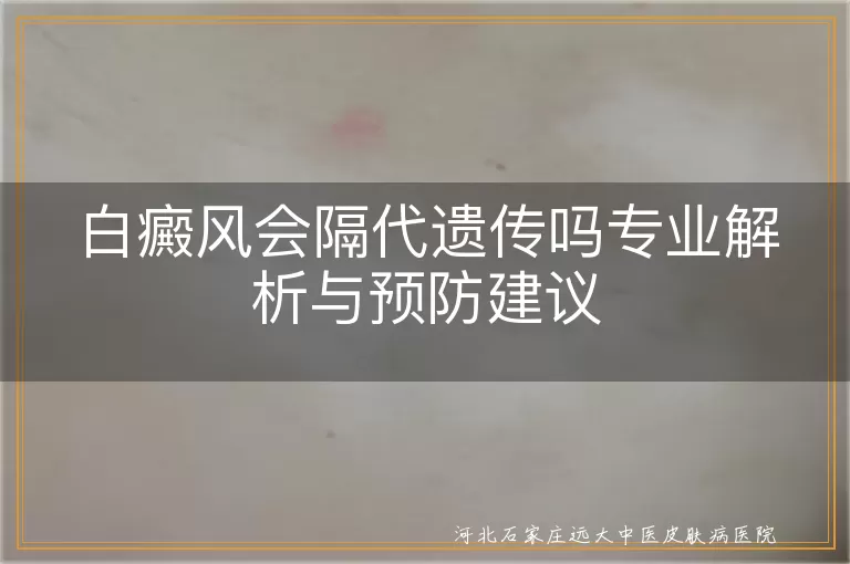白癜风会隔代遗传吗,白斑隔代遗传的真相,白癜风遗传预防建议
