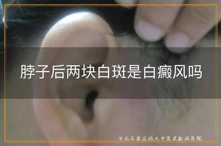 脖子后白斑是白癜风吗,颈部两块白斑是白癜风症状吗,后颈出现白块是不是白癜风