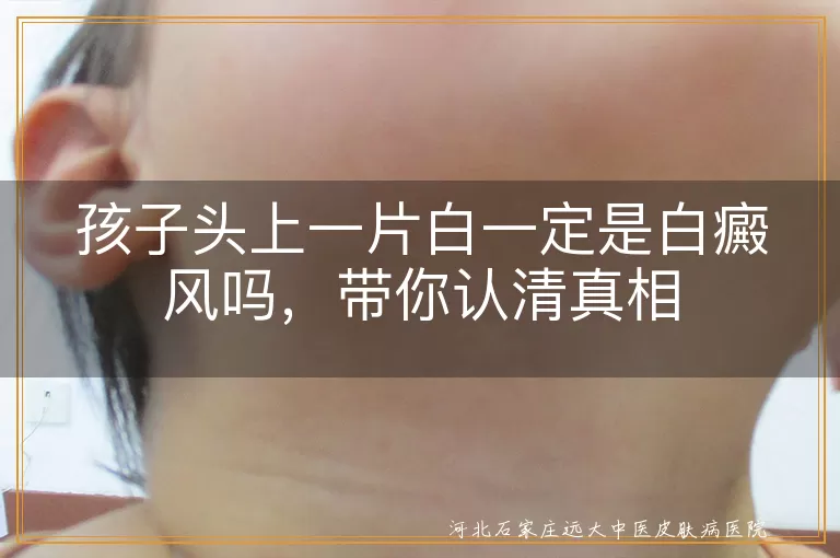 孩子头部白斑是白癜风吗,小孩头皮白块怎么回事,儿童头上长白斑如何辨别