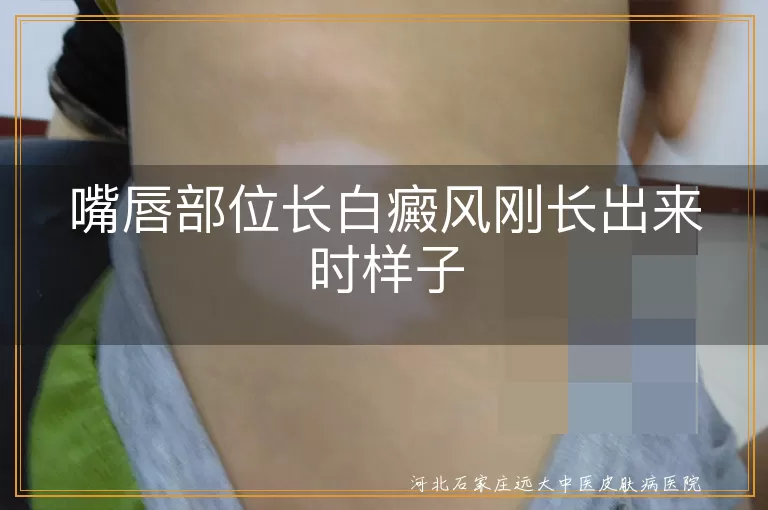 嘴唇白癜风刚开始的样子图片,嘴角白斑初期是什么形状,嘴唇上长白癜风早期症状描述,嘴唇部位白斑刚出现时什么样