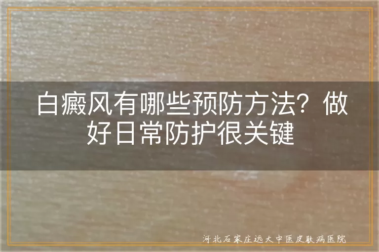 白癜风有哪些预防方法?做好日常防护很关键