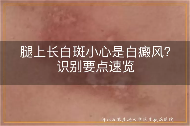 腿上长白斑小心是白癜风？识别要点速览