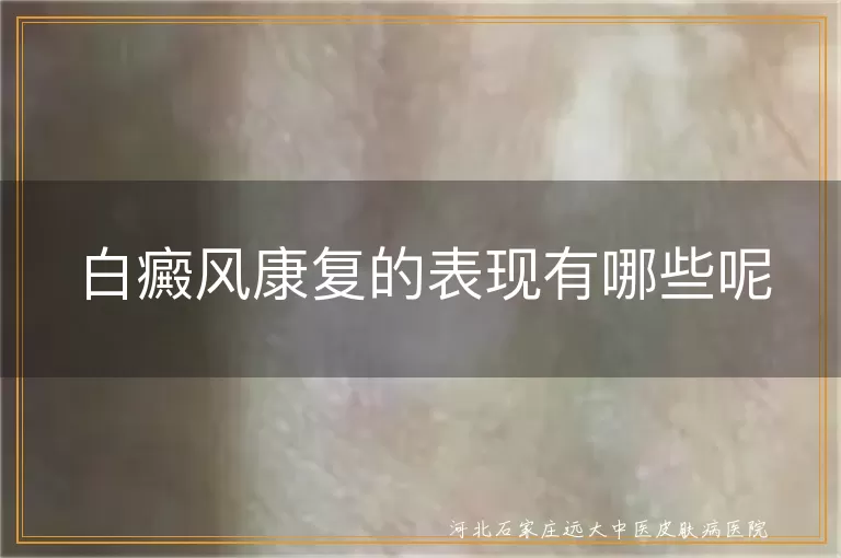 白斑康复期有哪些好转迹象,白癜风恢复过程中有什么征兆,白癜风开始变好的几个表现