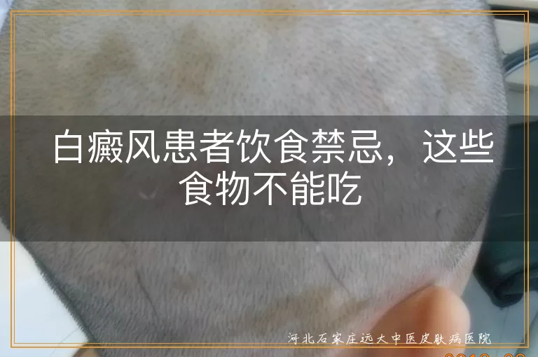 白癜风饮食禁忌食物清单,白斑患者不能吃什么食物,白癜风忌口注意这些饮食