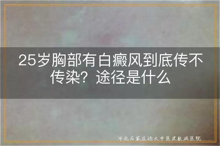 25岁胸部白癜风到底会不会传染,25岁得白癜风的传染途径是什么,胸部白斑会不会传染给其他人