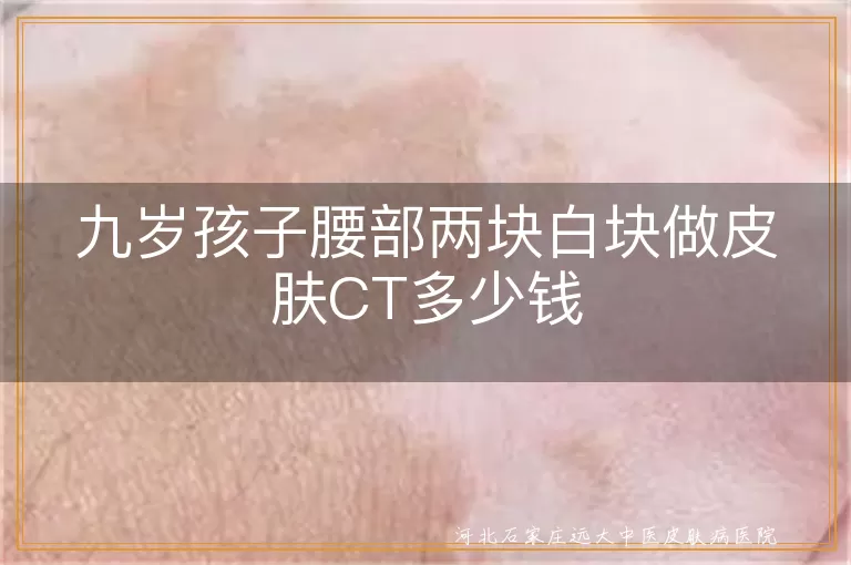 九岁孩子腰上白块CT检查多少钱,儿童腰部长白斑做皮肤CT费用,小孩腰上出现白癜风做CT价格
