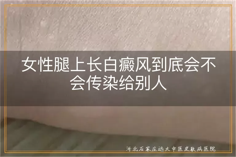 女性腿上长白癜风到底会不会传染给别人