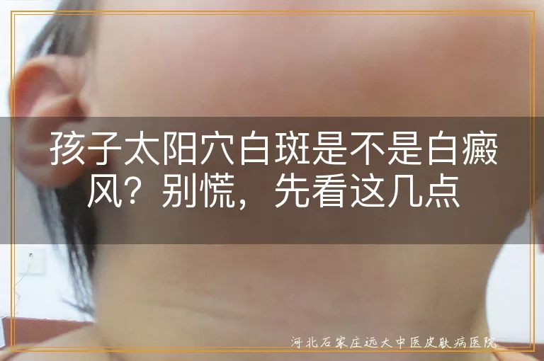 太阳穴有白斑是白癜风吗,孩子脸上白斑怎么回事,儿童白斑和白癜风区别,孩子太阳穴白斑咋判断