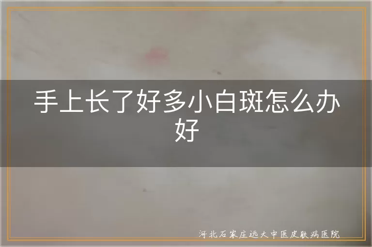 手上长小白斑是白癜风吗怎么办,手上白斑怎么消除有哪些方法,手上有白斑迟迟不退怎么回事