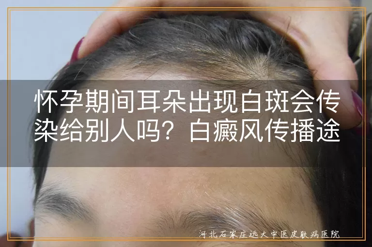 怀孕期间耳朵出现白斑会传染给别人吗？白癜风传播途径一文讲清