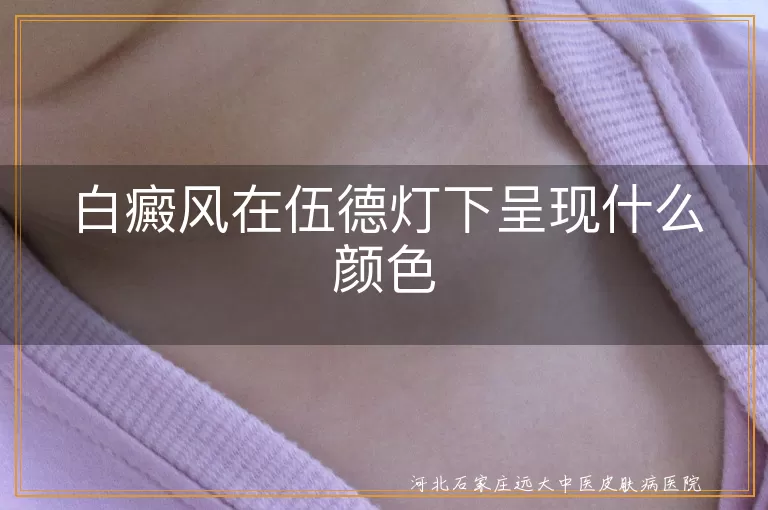 伍德灯下白斑是什么颜色,白癜风伍德灯下颜色什么样,白斑在伍德灯下颜色表现