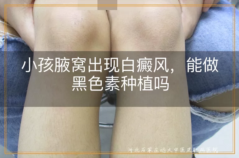 孩子腋下白斑可以种植黑色素吗,儿童腋窝白癜风能不能做种植,小孩腋下白癜风种植黑色素行吗