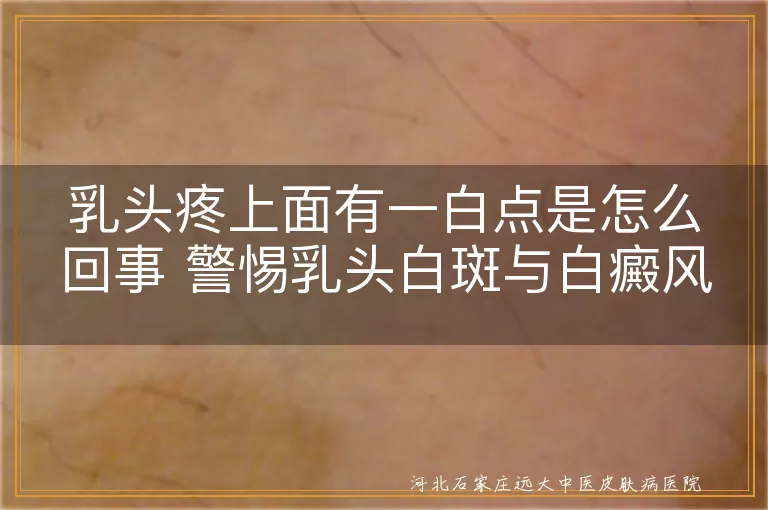 乳头疼有白点是白癜风吗,乳头白斑疼怎么回事,乳头白点疼会不会是白癜风