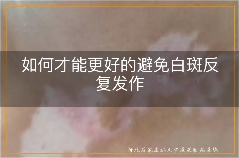 如何才能更好的避免白斑反复发作