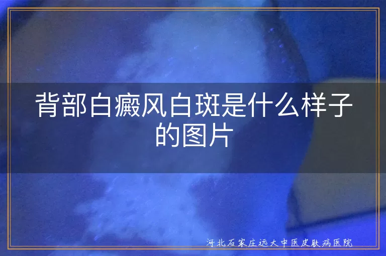后背白斑是不是白癜风初期样子,背部白癜风长什么样的白斑图,白癜风白斑在背上的症状图片