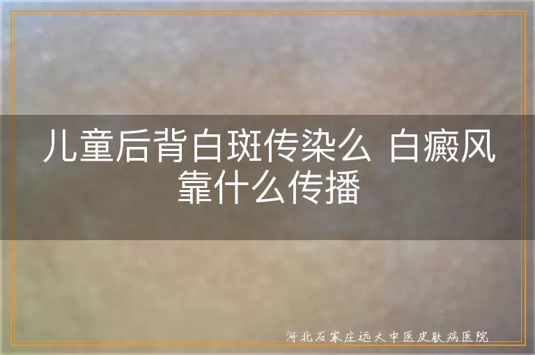 儿童后背白斑会不会传染人,白癜风通过什么途径传播,小孩背上长白斑病传染吗
