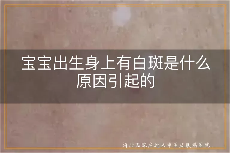 宝宝出生有白斑是白癜风吗,新生儿身上白斑原因有哪些,婴儿皮肤长白斑怎么辨别