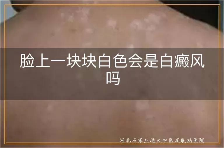 脸上白一块块是不是白癜风,面部有白斑是白癜风初期吗,脸上白斑怎么判断是白癜风
