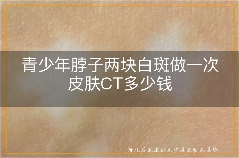 青少年脖子白斑CT检查费用,脖子白块做皮肤CT多少钱,青少年白癜风皮肤CT多少钱