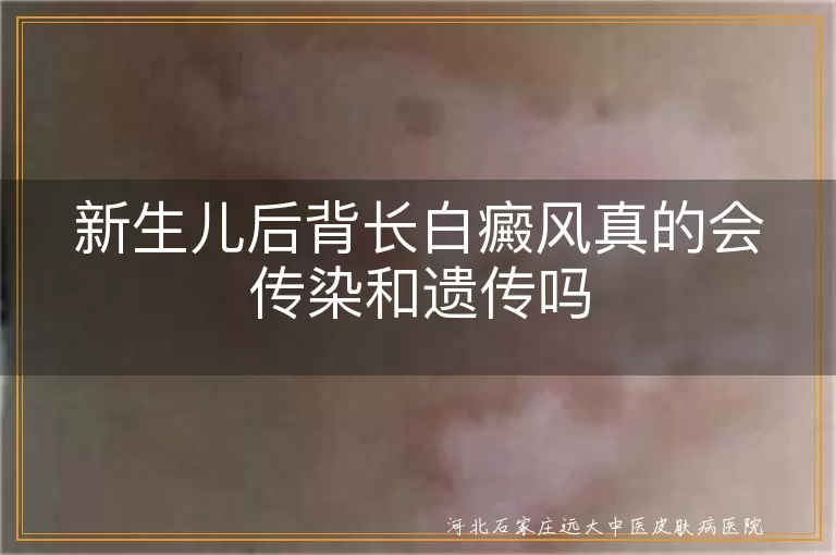新生儿后背白癜风会传染给家人吗,宝宝后背长白斑遗传概率有多大,婴儿背部长白癜风传染和遗传真相
