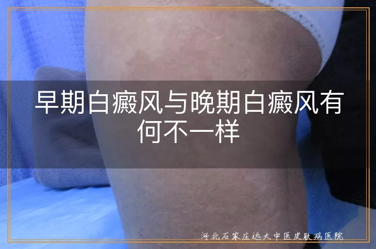 早期白癜风与晚期白癜风有何不一样