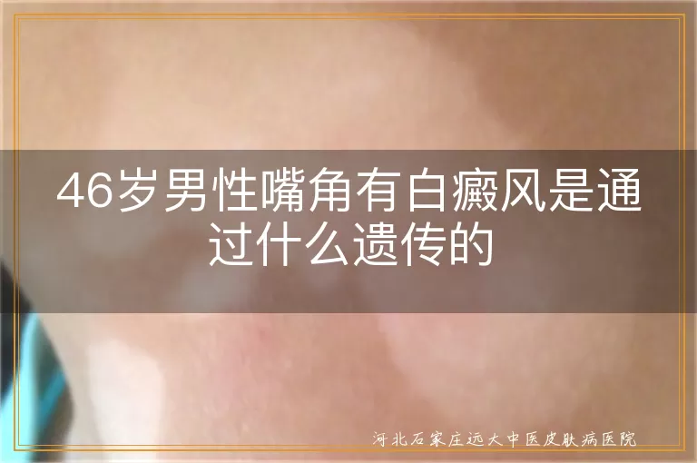 46岁男性嘴角有白癜风是通过什么遗传的