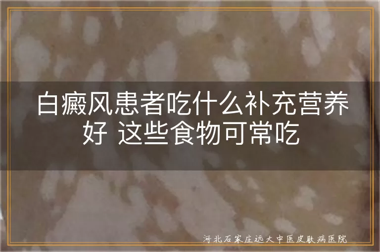 白癜风患者吃什么补充营养好 这些食物可常吃
