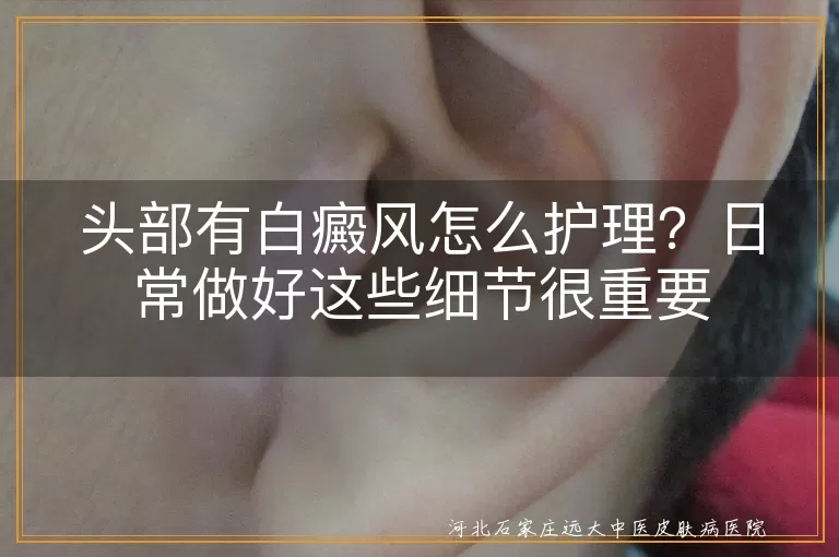 头部出现白癜风怎么正确护理,头皮白斑日常护理的注意事项,头部白癜风护理方法有哪些呢