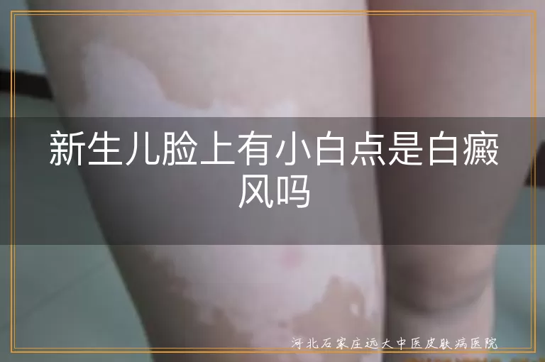 新生儿脸上白点是白癜风吗,宝宝脸上白斑怎么回事新生儿,婴儿脸上小白点是不是白斑